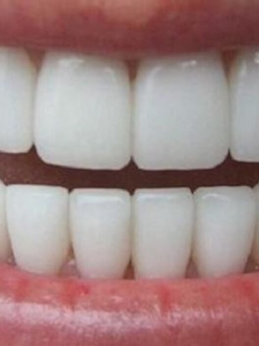 dents blanches