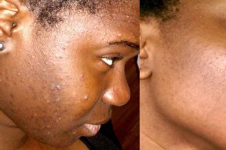 traiter l’acné
