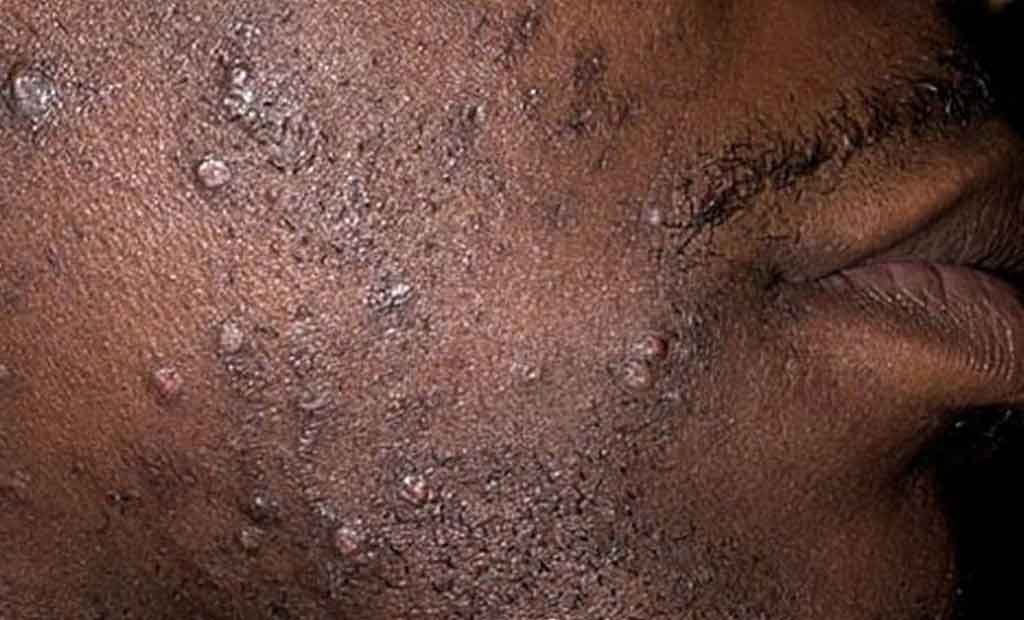 Comment combattre les boutons aprèsrasage Bienêtre