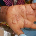 Lutte contre l’épidémie Mpox en RDC