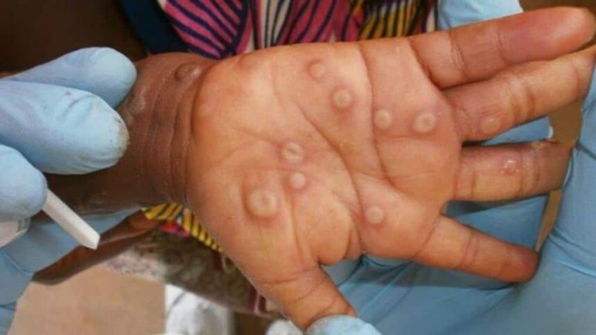 Lutte contre l’épidémie Mpox en RDC